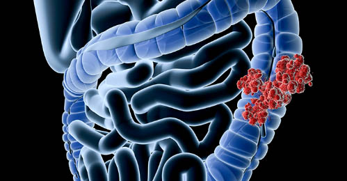 Colorectal Cancer Awareness Month