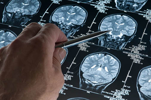 Stages of Alzheimer’s Disease