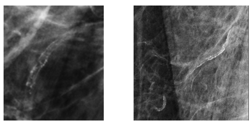 Breast Arterial Calcification on a Mammogram image