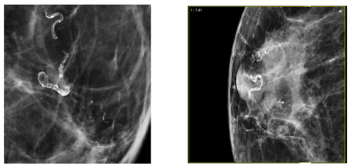 Breast Arterial Calcification on a Mammogram image
