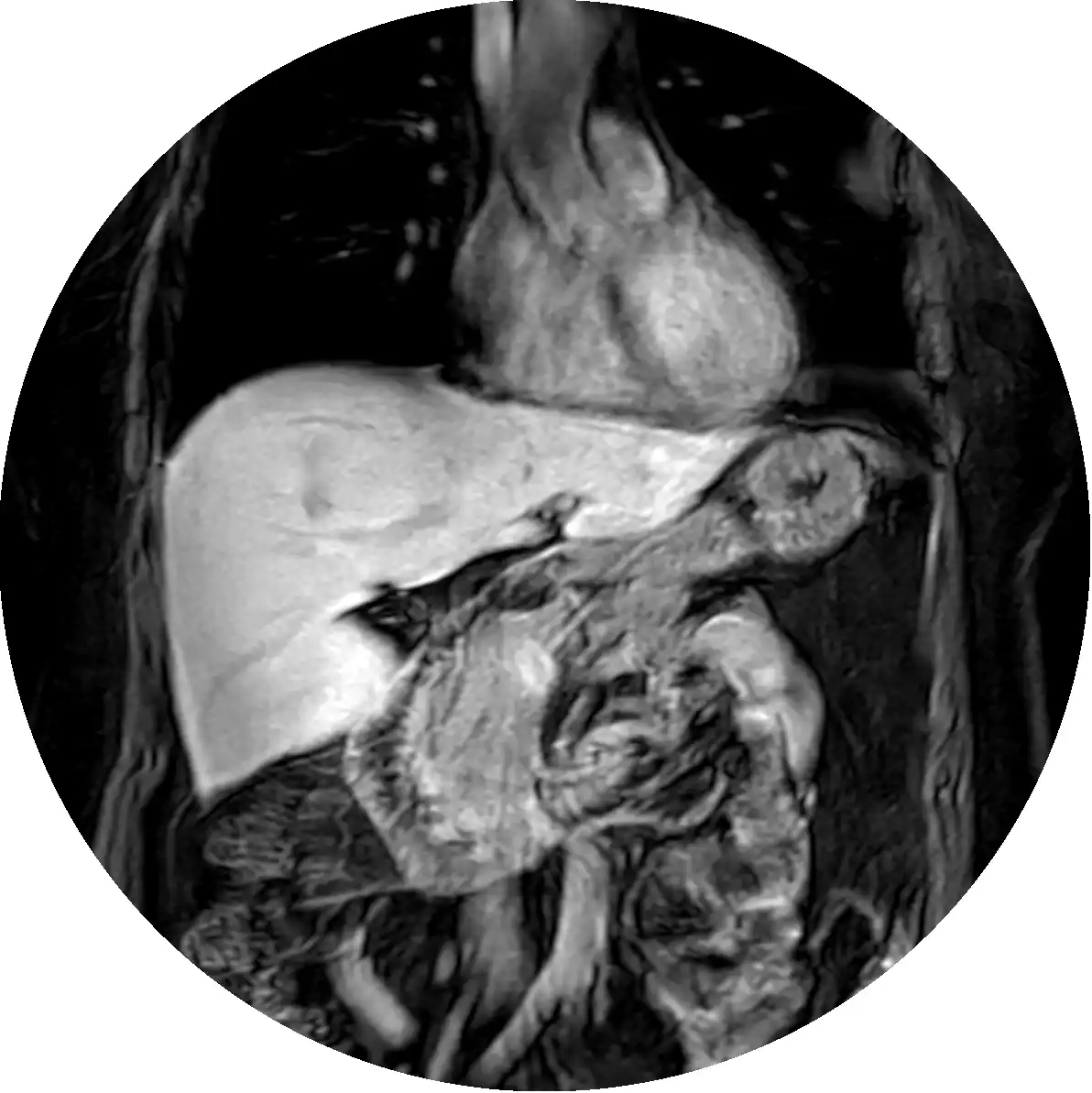MRI Liver w/ Eovist® Contrast