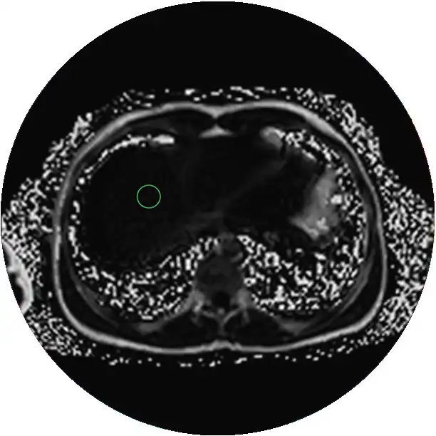 MRI Abdomen Non-Contrast (with Liver Iron Quantification)
