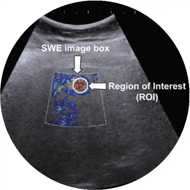 Ultrasound Elastography