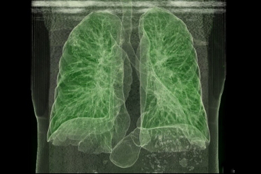 Screening for Lung Cancer with Low-Dose CT