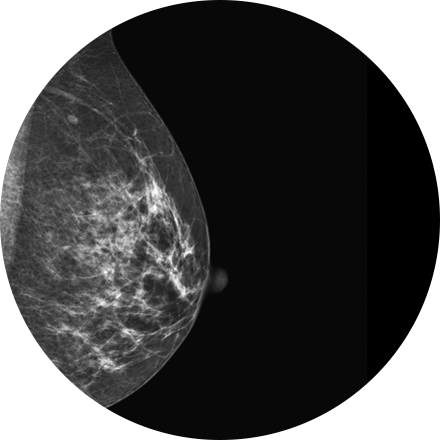 Digital Mammography Image