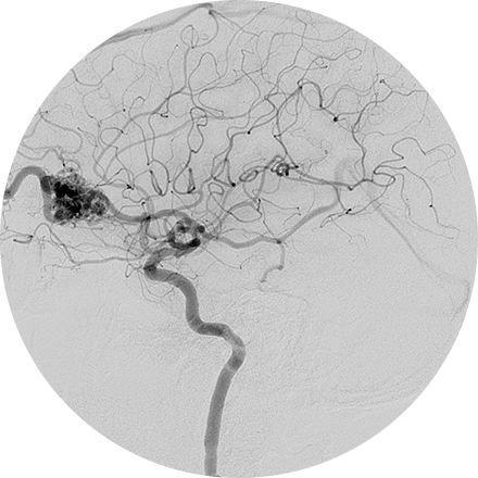 Angiography Image