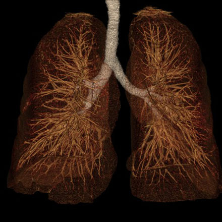 What are the benefits of lung cancer screening?