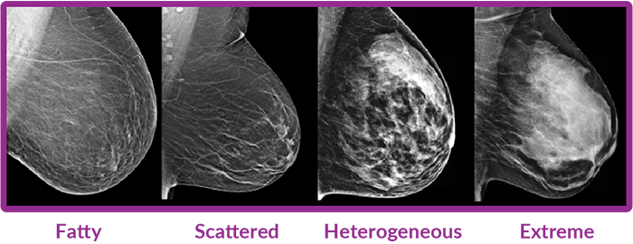 Types of breast tissue density: fatty, scattered, heterogeneous, and extreme