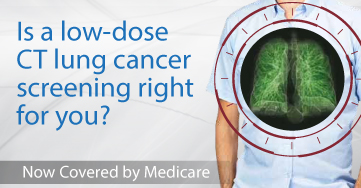 LDCT Lung Cancer Screening Campaign