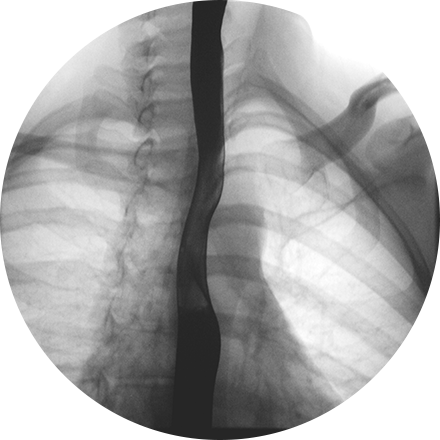 Fluoroscopy Image