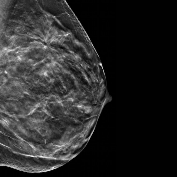 How Does Mammography Help?
