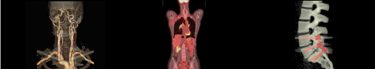 64-Slice PET/CT Now Available at Elite Advanced Imaging